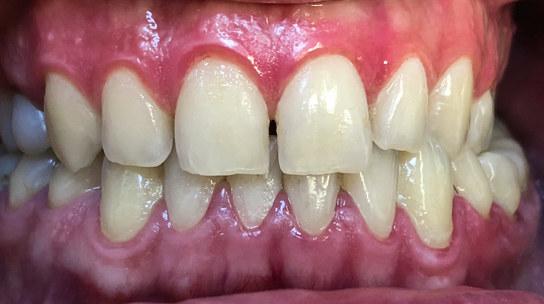 Full,Mouth,Veneers