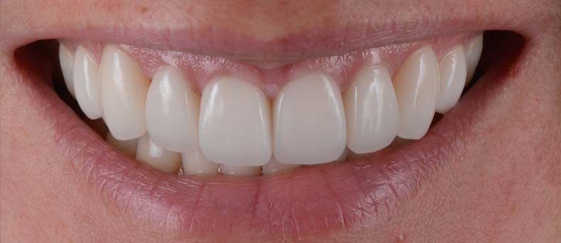 Smile,Makeover,With,Porcelain,Laminated,Veneers,,Before,And,After.